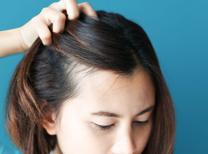 The Importance of Treating Dry Flaky Scalp: A Guide to Healthier Hair