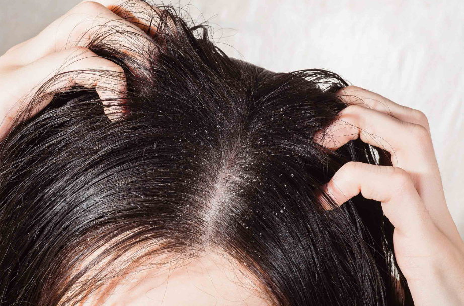 treating a dry flaky scalp 