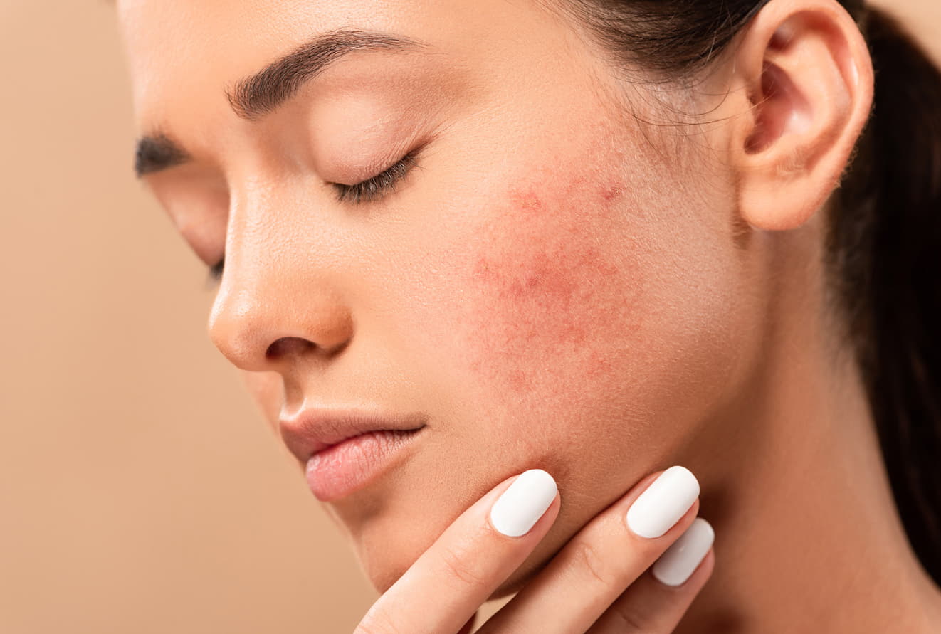 Why a Specialized Acne Treatment Centre is Your Best Bet for Clear Skin?