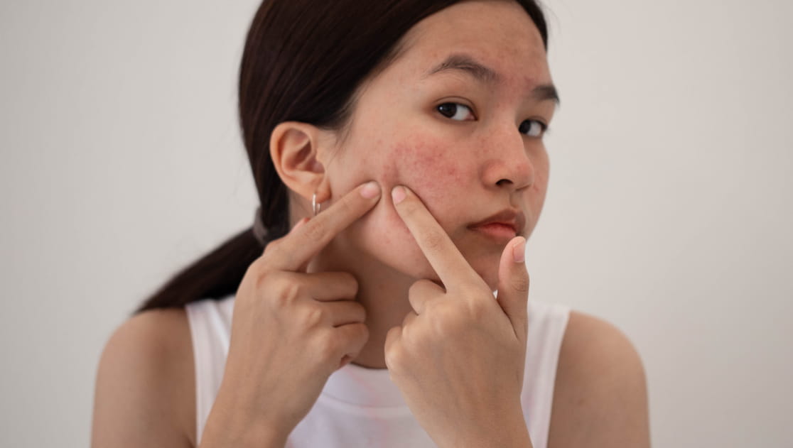 acne treatment centre